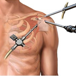 Revision Surgeries
