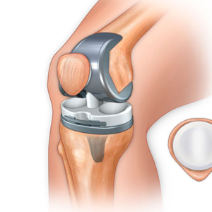 Hip Replacement & Surgeries