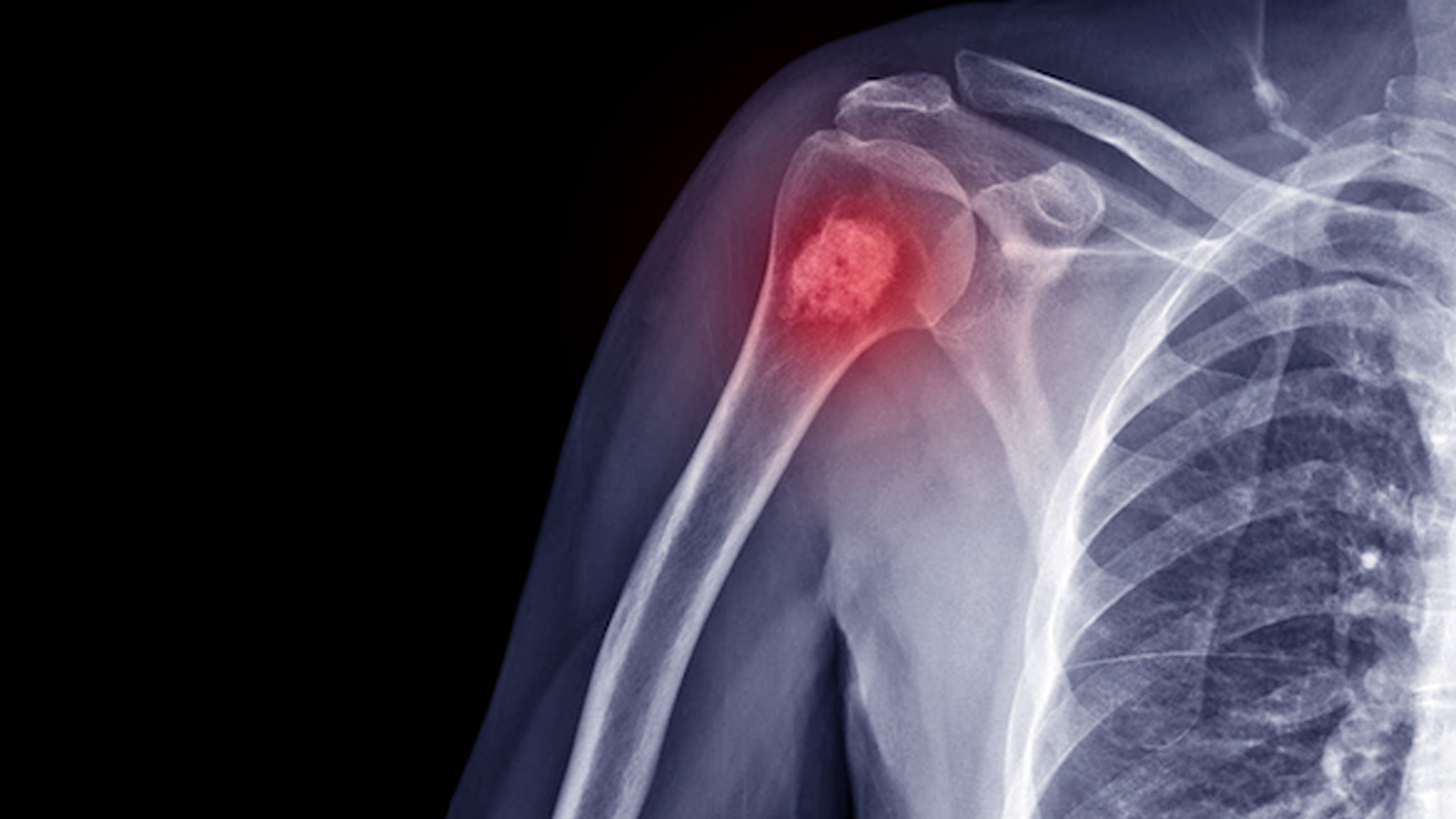 Arthroscopy